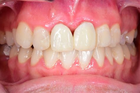 Receding Gums Causes Symptoms And Treatment Gum Recession
