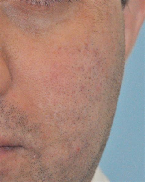 Acne Scar Vitalizer Treatment Seattle And Bellevue