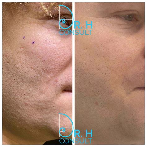 Subcision For Acne Scars London And Surrey Uk Dr H Consult
