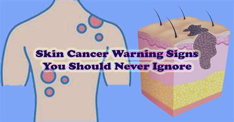 5 Warning Signs Of Skin Cancer