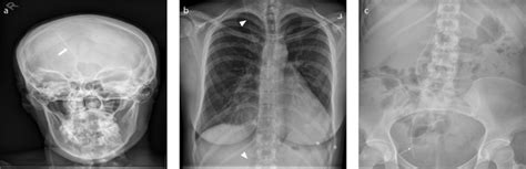 Jetzt stöbern und günstig online kaufen! What Organ Is Behind Your Right Lower Rib And Cup Hood ...