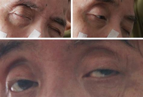 Stroke Patients Ability To Respond To Object From Opening His Eyes