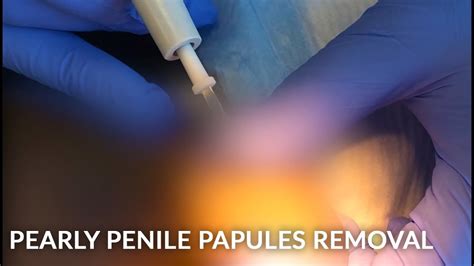 Fordyce Spots Penile Pearly Papules On The Penis Glands Remove The Warty Growths Dr Jason