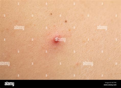 Close Up Picture Of Red Pimple On Human Skin Stock Photo Alamy