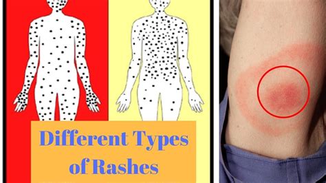 Common Rashes Skin Chart Vrogue Co