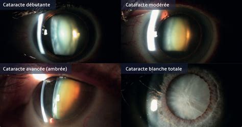 La Cataracte La Cerisaie Eye Clinic