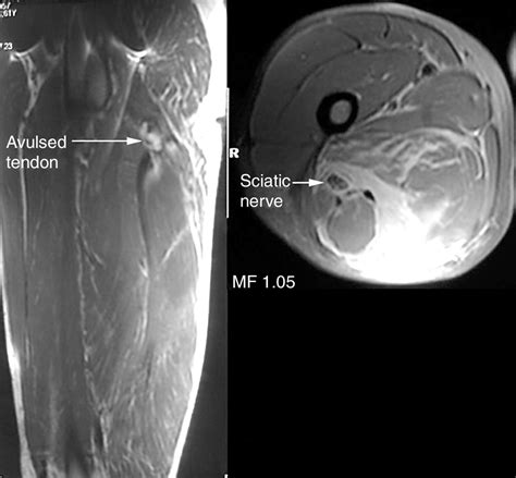 Hamstring Avulsion Fracture