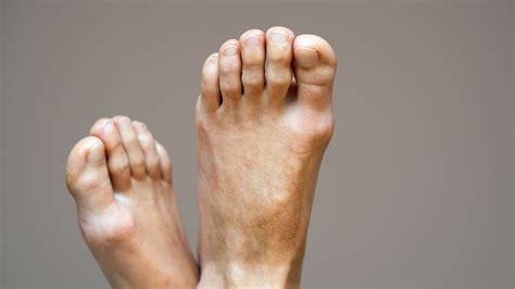 Corns And Calluses Treatment The Foot Practice Singapore