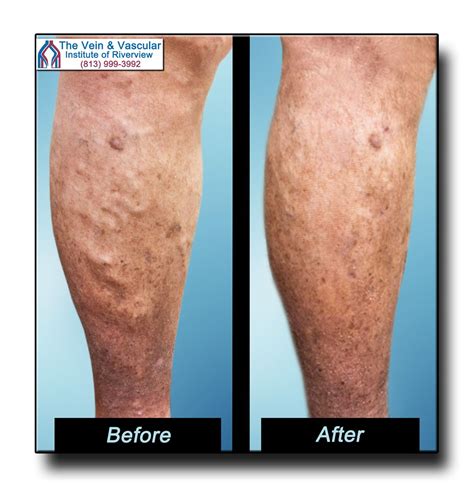 Pin On Riverview Varicose Vein Removal Before And After Pictures
