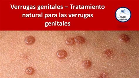 Formas De Deshacerte De Las Verrugas Genitales Con Remedios Caseros The Best Porn Website