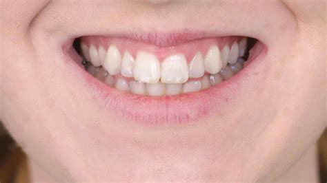 The Best How To Get Rid Of White Spots On Teeth Fast Ideas