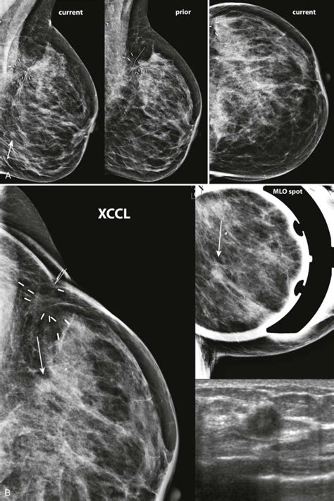 Mammographic Asymmetries Radiology Key