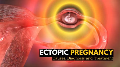 Ectopic Pregnancy Causes Signs And Symptoms Diagnosis And Treatment Youtube