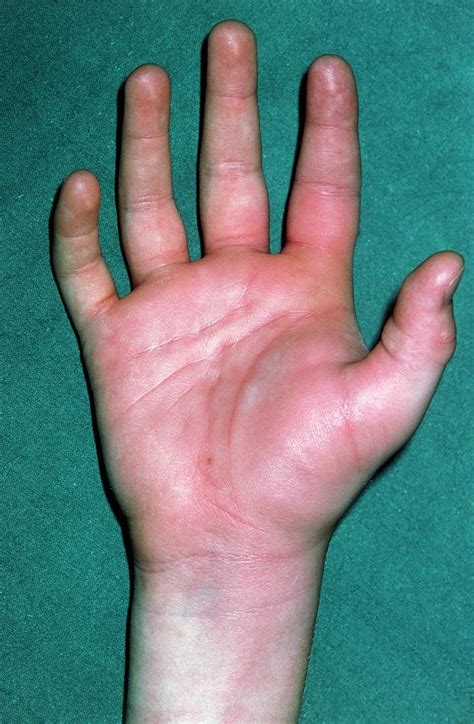 Childs Swollen Hand Due To An Infected Wasp Sting Photograph By Dr P