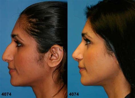 Ethnic Rhinoplasty In New York City Dr Philip Miller