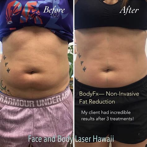 Non Invasive Fat Reduction Honolulu Face And Body Laser