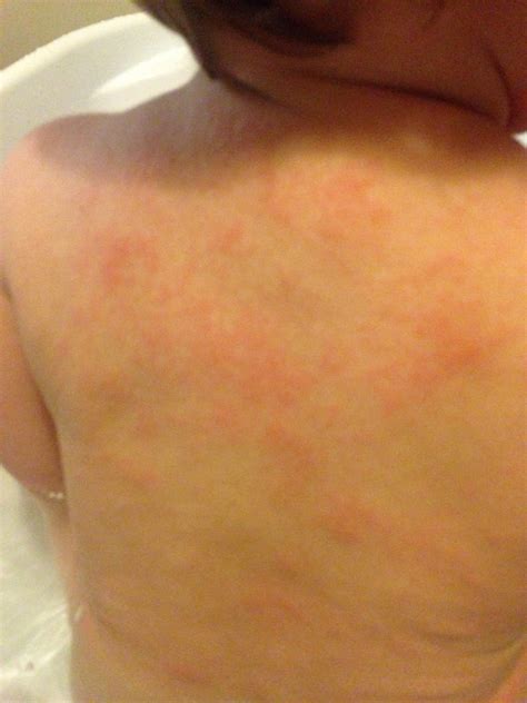 The next time you eat it, since your body thinks the food is bad, it'll release the chemical histamine, which causes allergy symptoms such as rashes, itching, and swelling. Food allergy? Eczema? | Netmums