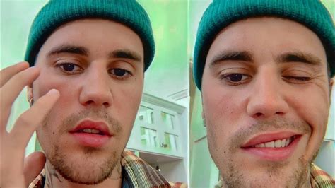 Justin Bieber Face Paralysis Full Interview With English Subtitle