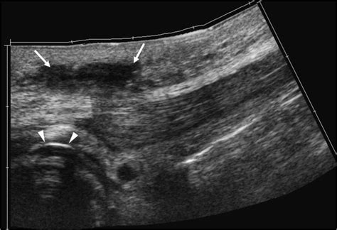 Anterior Abdominal Wall Abscess At The Gastrostomy Tube Site In An