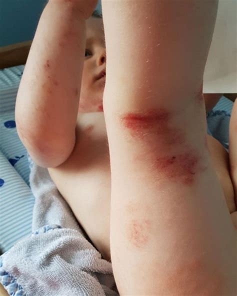 Eczema Cream Baby Boys Rash On Face ‘really Improved