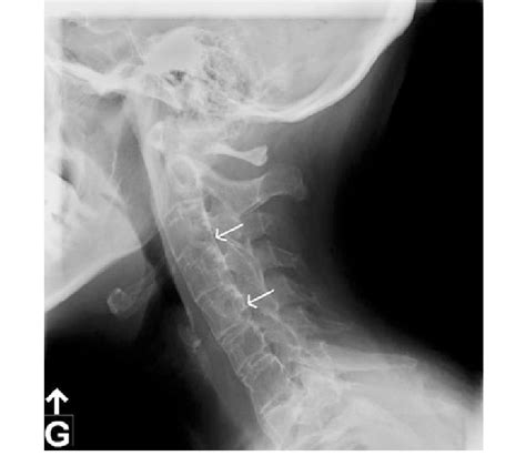 Figure Cervical Spine X Ray Of The Patient White Arrows Display Severe