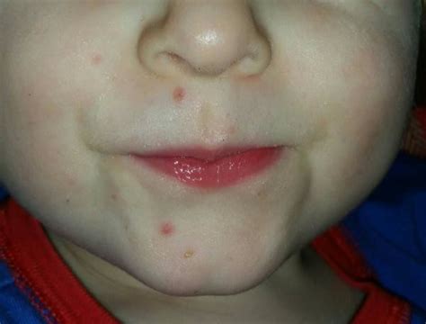 Spots Around 3 Year Old Mouth Netmums Chat