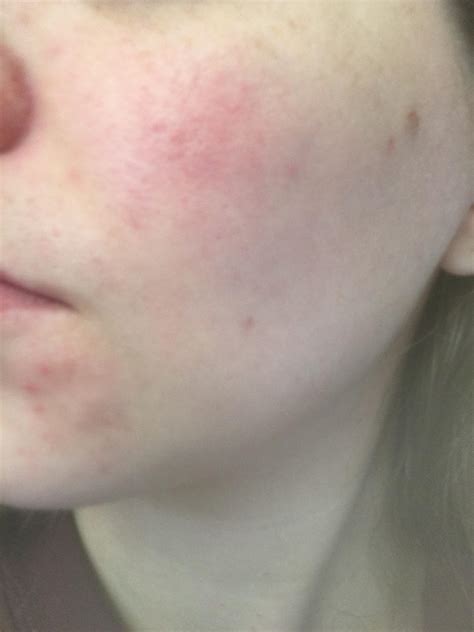 Skin Concerns All Of A Sudden My Left Cheek Is Irritated Red And Bumpy Is This Rosacea