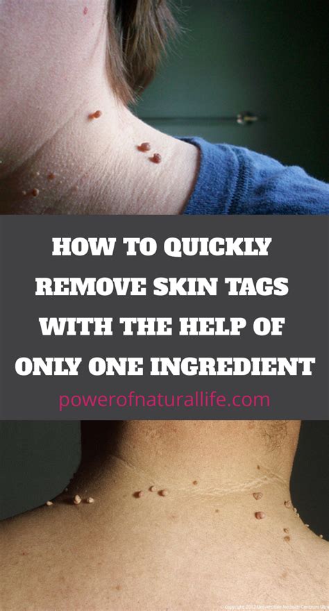 How To Quickly Remove Skin Tags With The Help Of Only One Ingredient