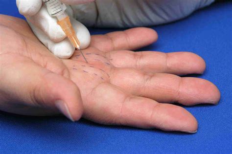 How to remove cactus needles. Trigger Finger Injections