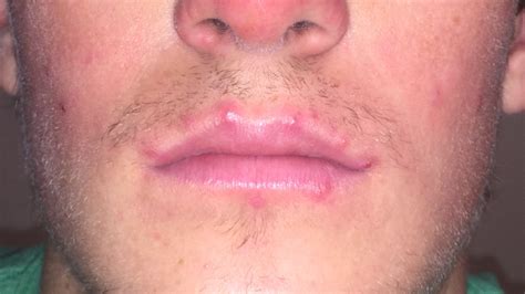 Multiple Pimples Around Edges Of Lips General Acne Discussion Acne
