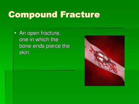 Compound Fracture Ultimatexoler