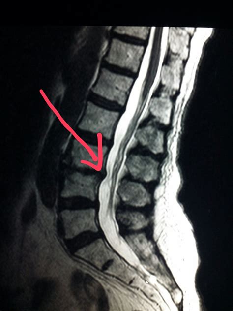 Color Mri Of A Lumbar Disc Herniation Shown As A Horizontal Slice My