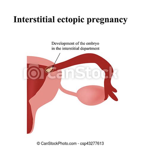 Development Of The Embryo In The Interstitial Department Ectopic