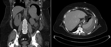 Ct Abdomen Demonstrating Air And Fluid Contained With The Splenic