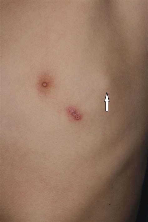 10 Year Old Boy Presents With Swollen Lymph Nodes Ulcerative Lesions