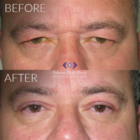 Natural Looking Eyelid Lift Surgery By Leading Cosmetic Eye Surgeon