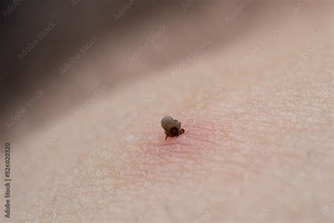 Sucking A Tick Macro Photo On Human Skin Ixodes Ricinus The Swollen