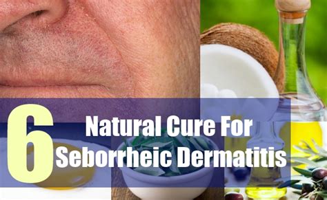 6 Natural Cure For Seborrheic Dermatitis Natural Treatments And Cure