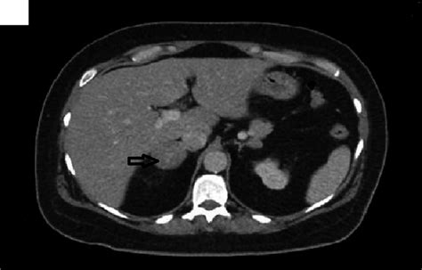 Ct Of The Abdomen With Contrast Showing 4 Cm Right Adrenal Adenoma
