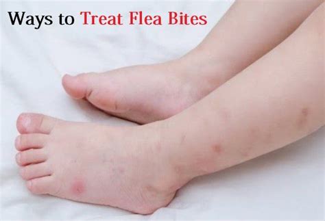Ava discusses how to treat bug and flea bites, how to prevent them, and what to do about scarring from bug.how many scars do you have on your body from pesky mosquitoes? Pin on Home remedies