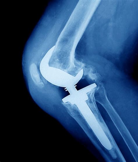 Knee Replacement Photograph By Zephyr Science Photo Library Pixels