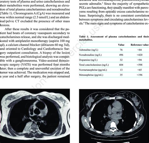 Cardiac Magnetic Resonance Imaging Showing A Right Paravertebral Mass