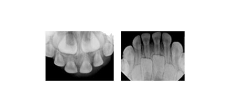 X Rays The Tooth Photos