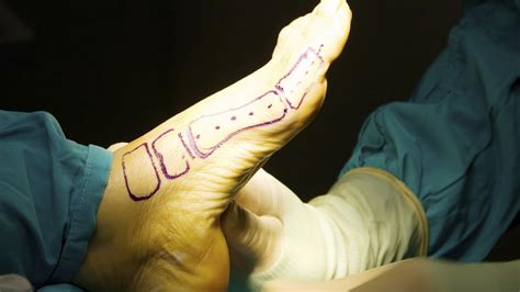 Foot And Ankle Gallery Orthopaedic Surgery Michigan Medicine