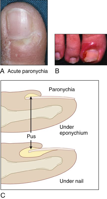 In Detail Scientist To Expose Antibiotic Ointment For Paronychia