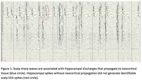 Sensitivity Of Scalp Eeg In Detecting Intracranial Interictal Spikes In