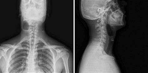 Plain X Ray Neck Showing Air Filled Space In The Soft Tissue Neck On