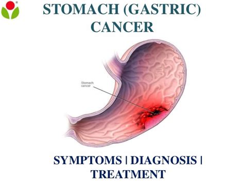 In other cases, stomach cancer patients may mistake their. What is Stomach Cancer? Stomach Cancer Symptoms, Diagnosis ...