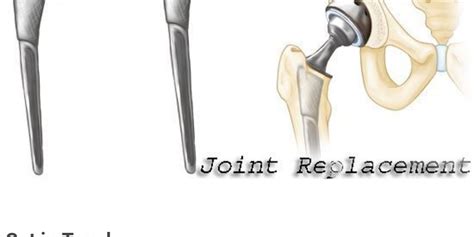 Joint Replacement Joint Replacement Joint Healthy Joints