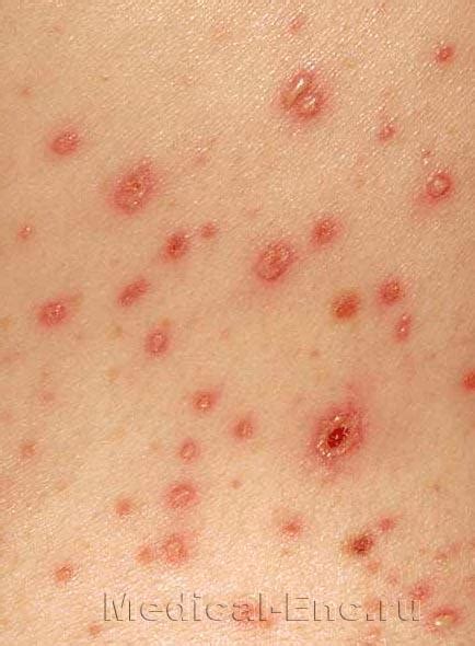 The itchy blister rash caused by chickenpox infection appears 10 to 21 days after exposure to the virus and usually lasts about five to 10 days. Chicken pox chicken pox (varicella)